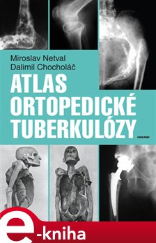 Levně Atlas ortopedické tuberkulózy - Miroslav Netval, Dalimil Chocholáč e-kniha