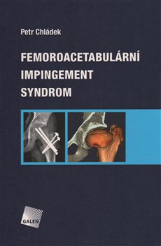 Femoroacetabulární impingement syndrom koupíte na Kosmas.cz