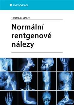 Normální rentgenové nálezy koupíte na Kosmas.cz