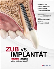 Zub vs. implantát: Zachovat, či nahradit vážně poškozený zub? - Pio Bertani, Paolo Generali, Fabio Gorni, Tiziano Testori,  kolektiv