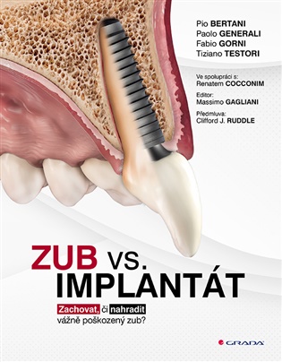 Zub vs. implantát: Zachovat, či nahradit vážně poškozený zub? - Pio Bertani, Paolo Generali, Fabio Gorni, Tiziano Testori,  kolektiv