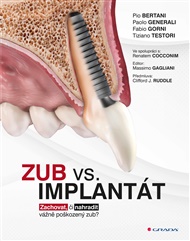 Zub vs. implantát: Zachovat, či nahradit vážně poškozený zub? - Pio Bertani, Paolo Generali, Fabio Gorni, Tiziano Testori,  kolektiv