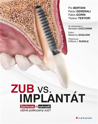 Zub vs. implantát: Zachovat, či nahradit vážně poškozený zub? - Pio Bertani, Paolo Generali, Fabio Gorni, Tiziano Testori,  kolektiv